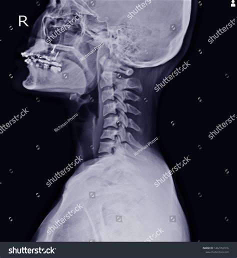 Xray Cervical Spine Showing Thoracic Scoliosis Foto Stock 1462762916