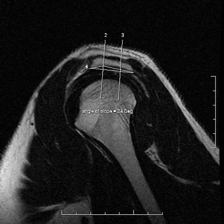 Acromion Types Radiology