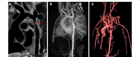 Multiple Cmr Methods Of Imaging Coarctation Of The Aorta A Sagittal Download Scientific