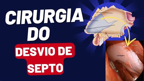 Cirurgia Do Desvio Do Septo Explicada Youtube