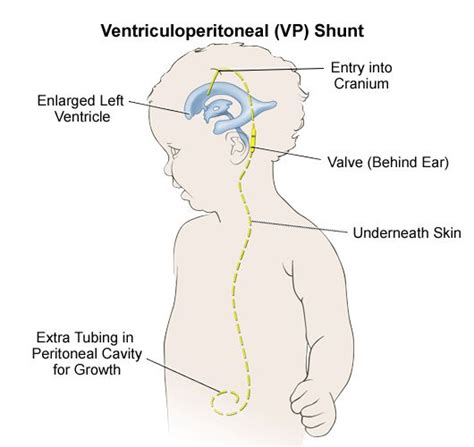 92 best Hydrocephalus/Shunt images on Pinterest | Chiari malformation, Chronic pain and Chronic ...