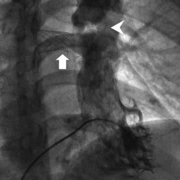 RV angiogram demonstrating stent in RPA with in-stent stenosis ...