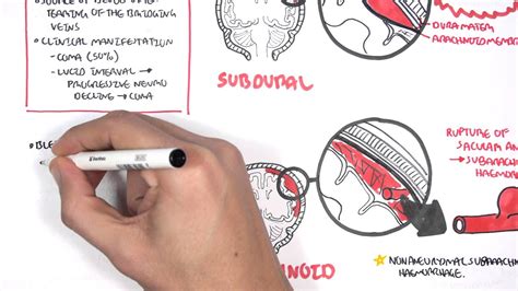 Intracranial Haemorrhage Types Signs And Symptoms Youtube