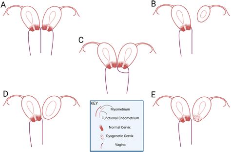 Presentation And Management Of Uterine Didelphys With Unilateral Cervicovaginal Agenesis