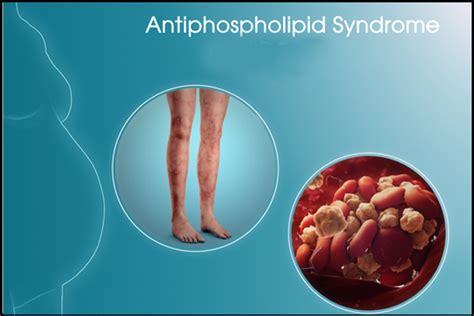 Herbal Remedies For Antiphospholipid Syndrome Causes And Symptoms