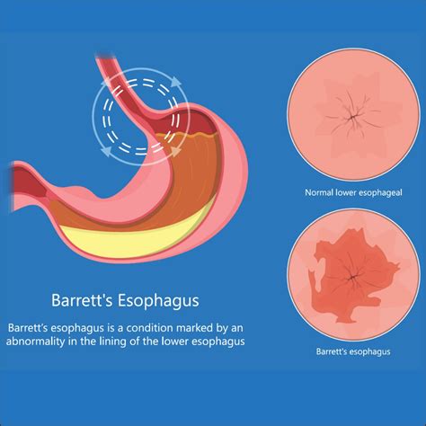 Barrett S Esophagus Causes Risk Factors Symptoms Treatment