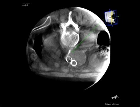 Embolization Of Type Ii Endoleak Via Translumbar Access Calculating