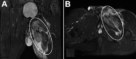 T2 Weighted Short Tau Inversion Recovery Magnetic Resonance Imaging A