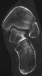 Degenerative Joint Disease Djd Ankle Joint Musculoskeletal Case