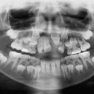 Pretreatment Occlusal Radiograph Showing The Dilacerated Impacted