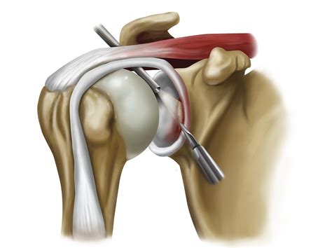 Bankart Tear on Behance