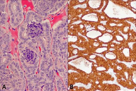 A And B Papillary Thyroid Carcinoma Cribriform Morular Variant A