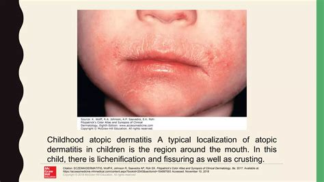 Atopic Dermatitis Ppt