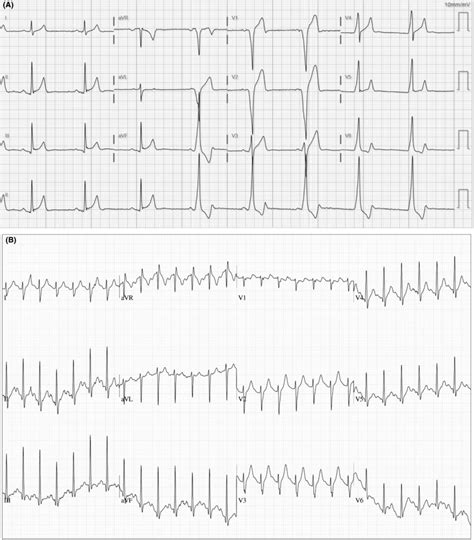 Panel A Resting Electrocardiogram Demonstrating Normal AV Conduction