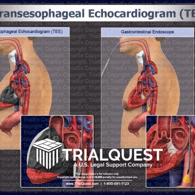 Transesophageal Echocardiogram (TEE) - TrialExhibits Inc.