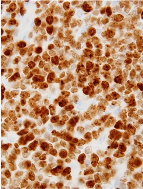 Extranodal Blastoid Pleomorphic Variant Of Mantle Cell Lymphoma Involving The Testis And Skin