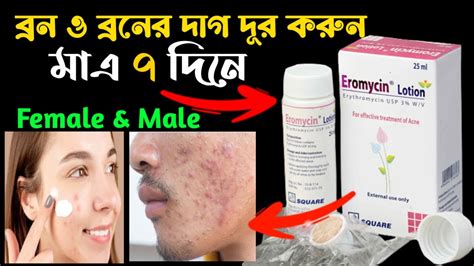 ব্রন ও ব্রনের দাগ দূর করুন মাএ ৭ দিনে😲eromycin Acne Removing Lotion