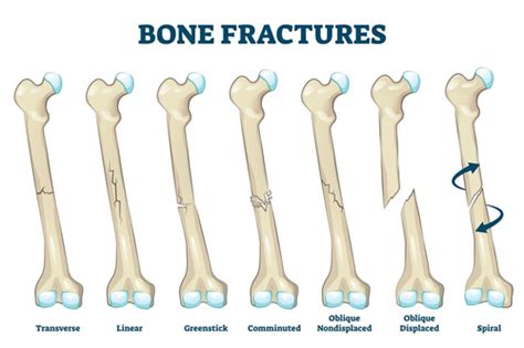 Musculoskeletal Test Med Surg Flashcards Quizlet