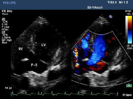 Echocardiography and surgical treatment of left ventricular ...