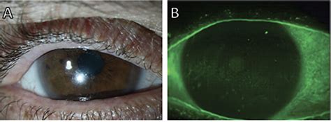 Corneal Physician Pentavision