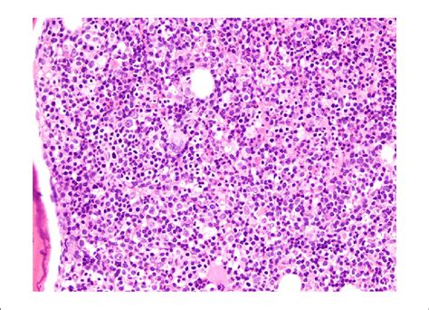 Hematoxylin And Eosin Stained Core Biopsy Of Patients Bone Marrow