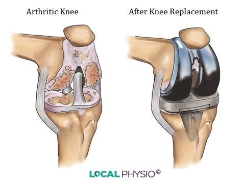 Knee Replacement Local Physio