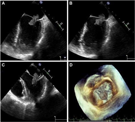 Transesophageal Echocardiography Midesophageal Window Two Dimensional Download Scientific