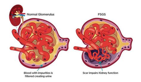 Glomerulosclerosis Medizzy