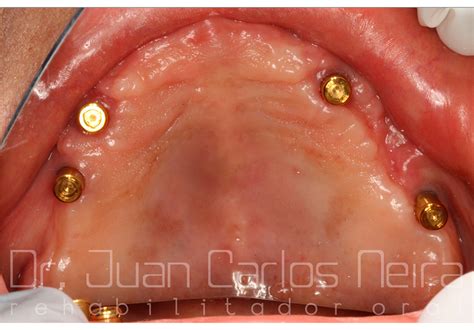 CASO 02 Sobredentadura Tipo Locator Sobre 4 Implantes Juan Carlos