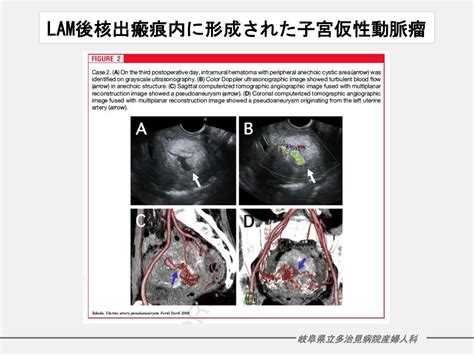 Ppt 皮下鋼線吊り上げ法による腹腔鏡補助下子宮筋腫核出術の治療成績 Powerpoint Presentation Id 5640126