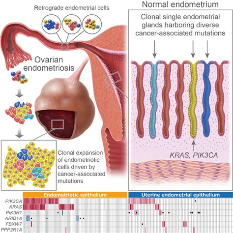 Landscape Of Somatic Mutations In Ovarian Endometriosis And Normal