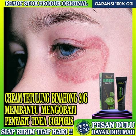 Jual Obat Tinea Corporissalep Obat Eksim Kulit Gatal Selangkangan