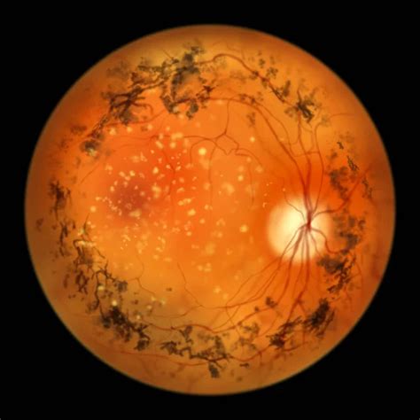 Retinitis Pigmentosa Una Enfermedad Gen Tica Ocular Una Ilustraci N