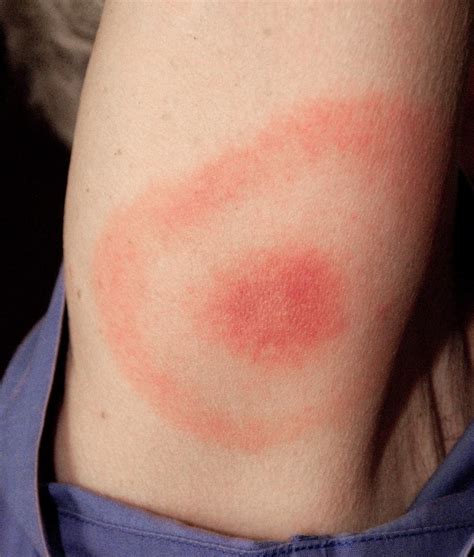 Rheumatic Fever Rash