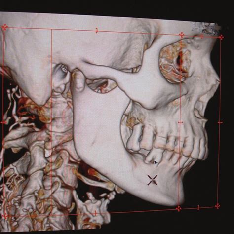 Fig.l: Ulceroproliferative lesion in right retromolar area. | Download ...