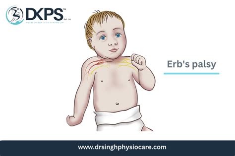 Erb's palsy: Symptoms, Causes & Treatment- DKPS Clinic