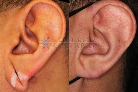 Earlobe Repair Washington DC Center For Laser Surgery