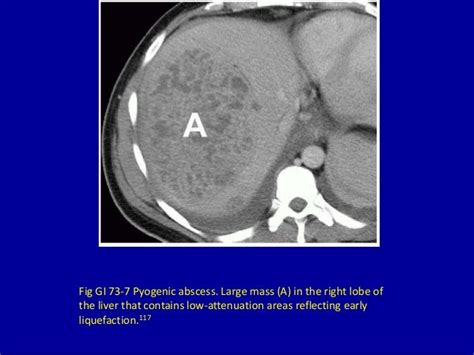 73 Focal Decreased Attenuation Masses In The Liver