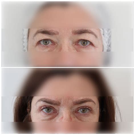 Blefaroplastie Clinica Estetica Dr Morad Iancu