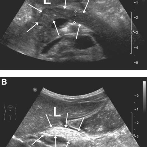 Pancreas Ultrasound Labeled