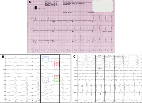 Baseline 12 Lead Electrocardiogram And Initial Electrophysiology Study