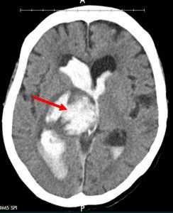 Basal ganglia hemorrhage – Radiology Cases