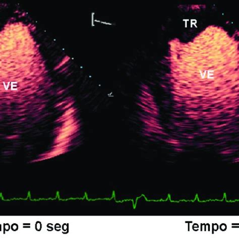 Ecocardiograma contrastado demonstrando ventrículo esquerdo dilatado