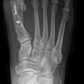 Scarf osteotomy with simultaneous Akin osteotomy. | Download Scientific Diagram