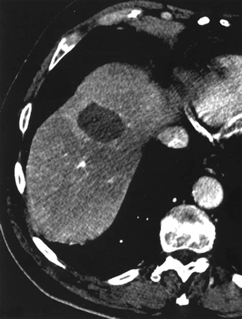 Percutaneous Saline Enhanced Radiofrequency Ablation Of Unresectable