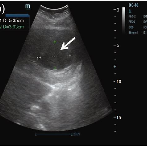 Abdominal color ultrasound of the liver. (a, b) Abdominal color... | Download Scientific Diagram