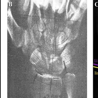 common methods  ulnar variance assessment