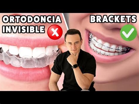 Comparativa De Precios Brackets Vs Ortodoncia Invisible Biolifedental