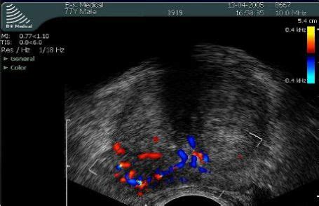 Trus Przezodbytnicze Usg Gruczo U Krokowego