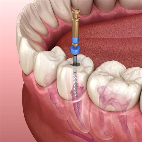 Todo Lo Que Necesitas Saber Sobre La Endodoncia Cl Nica Dental Tiiz